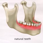 Lower mandible with Natural Teeth before extractions of the lower teeth