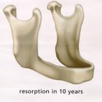 bone shrinkage in 10 years after extractions of lower teeth