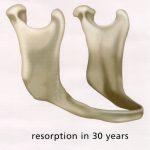 Bone shrinkage in 30 years after all natural teeth extracted on the lower arch mandible