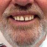 Brian - Before with old upper denture