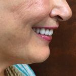 Side profile of Upper Perfit Digital Implant Denture