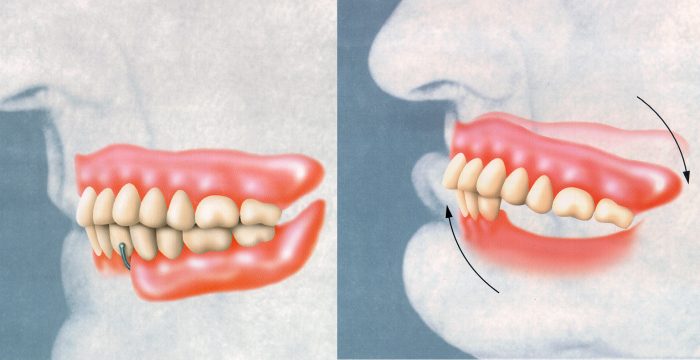 The Effects of Ill-Fitting Dentures